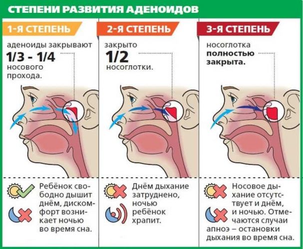 Комаровский: аденоиды 3 степени - лечение без операции у детей, как лечить в домашних условиях