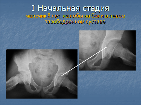 Болезнь пертеса – симптомы, лечение, формы, стадии, диагностика