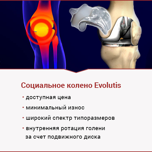 Повторное эндопротезирование искусственного сустава: как скоро понадобится?