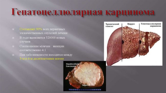 Гемангиома печени – симптомы, лечение, диета, причины
