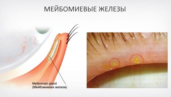 Что такое мейбомит глаза: причины и лечение