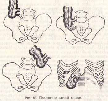 Клиническая картина острого аппендицита