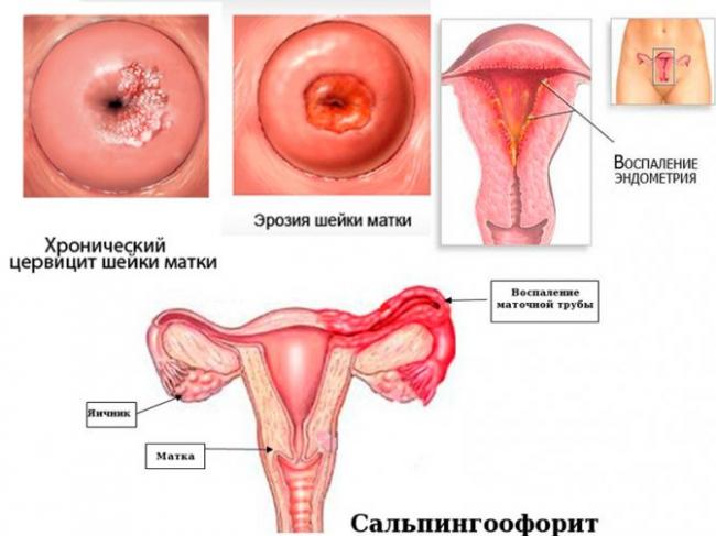 Основные причины возникновения вульвита у девочек