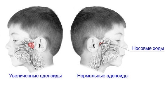 Лечение острого аденоидита у детей