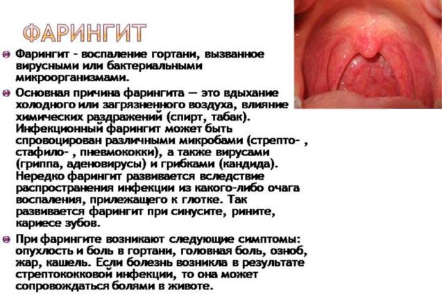 Все о фарингите: хроническая и острая формы болезни горла