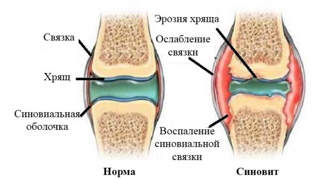 Синовит: суть болезни, причины, симптомы, диагностика и лечение