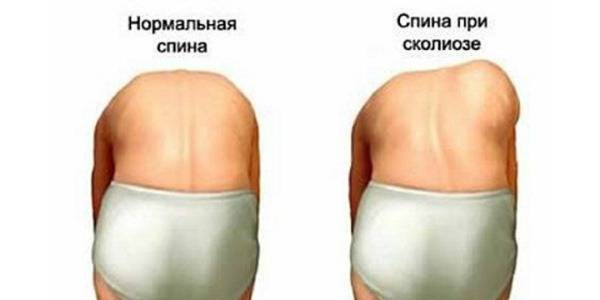 Как определить сколиоз на ранней стадии
