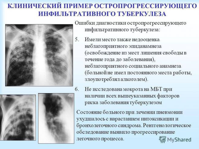 Сочетание туберкулеза и сахарного диабета - особенности течения