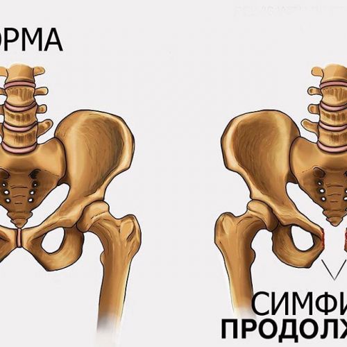 Симфизит, чем он страшен., больно ходить при беременности симфизит при беременности фото | метки: лонный, сочленение, где, находиться, расхождение | страница 3