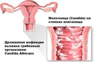 Как избавиться от грибка в организме: традиционные и народные методы, профилактика