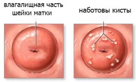 Киста шейки матки