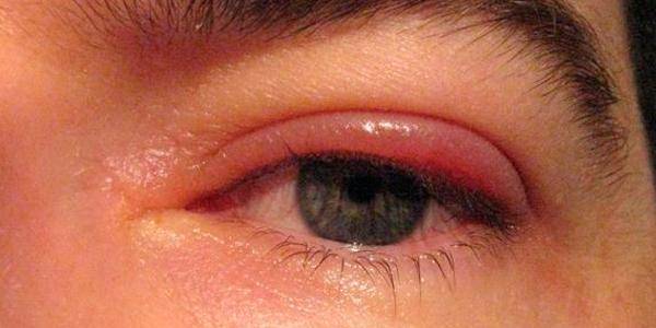 Отеки верхних век причины лечение народными средствами