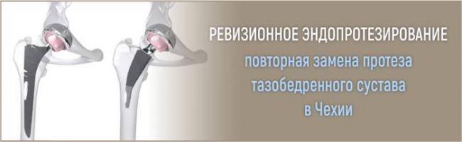 Осложнения и боли после эндопротезирования коленного сустава: список основных