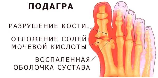 Лечебная диета при артрите суставов: питание при ревматоидной, подагрической и псориатической форме
