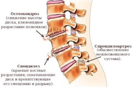 Остеохондроз шейного, грудного, поясничного отделов - симптомы и лечение заболевания - docdoc.ru