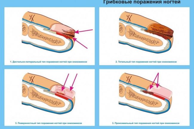 Ушные капли с антибиотиком и противогрибковым средством. список, цены