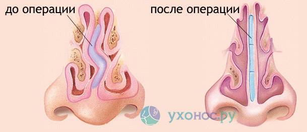 Воспаление после операций в полости носа и околоносовых пазухах: необходимость медикаментозного регулирования