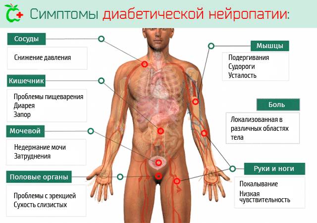 Диабетическая полинейропатия верхних и нижних конечностей