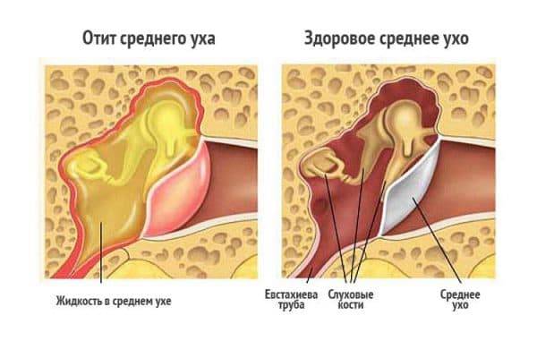 Лечение острой нейросенсорной тугоухости