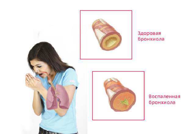 Применение электрофореза при бронхите и другие виды физиотерапии