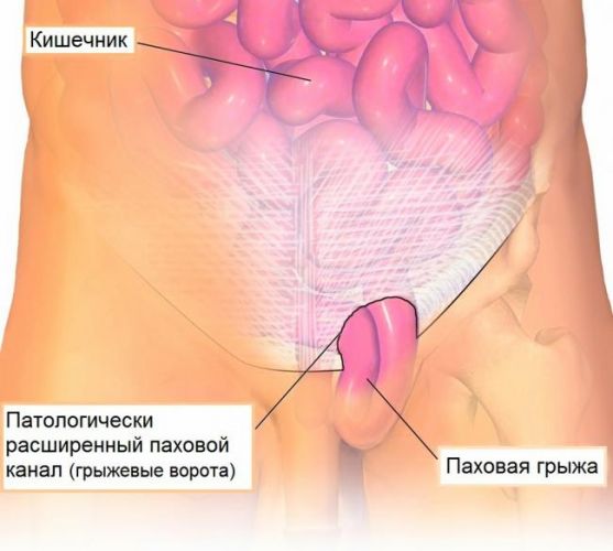 Почему возникает паховая грыжа, и нужно ли ее оперировать?