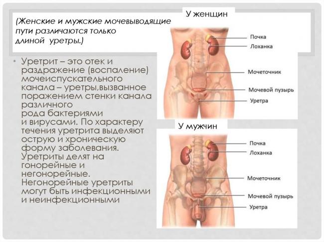 Уретрит у мужчин и женщин. причины, симптомы, признаки, диагностика и лечение уретритов. виды уретрита: острый, хронический, неспецифический, специфические виды уретрита . бактериальный, кандидозный, трихомонадный уретрит