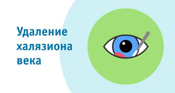 Лечение халязиона верхнего века без операции: как лечить халязион мазями и каплями