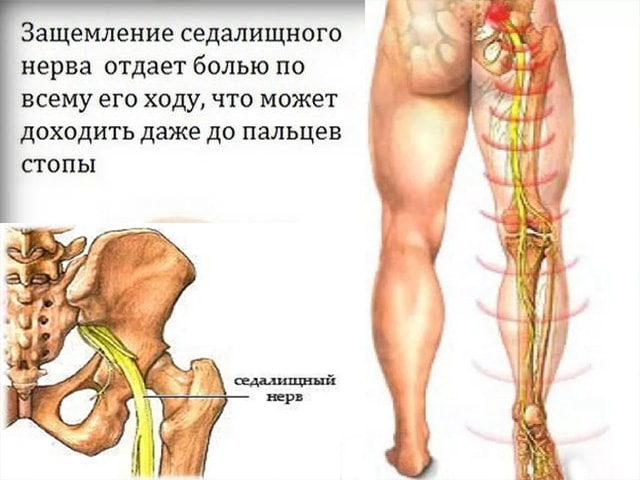 Что делать, если защемило нерв в шее