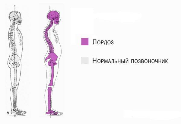 Подводное вытяжение позвоночника при остеохондрозе после обострения
