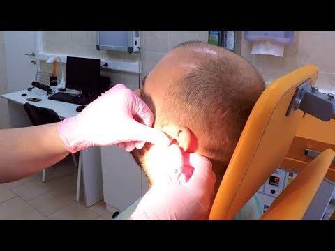 Серная пробка в ушах - лечение в домашних условиях, можно ли убрать самостоятельно