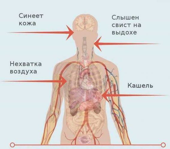 Применение антибиотиков при бронхиальной астме