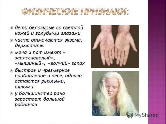 Фенилкетонурия у детей: особенности лечения и рекомендации врачей