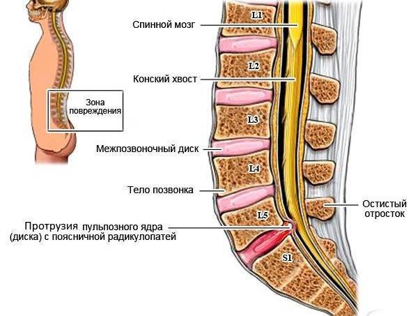 Как лечить протрузию дисков l4-l5 и l5-s1