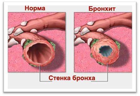 Порошок, сироп и таблетки для детей АЦЦ