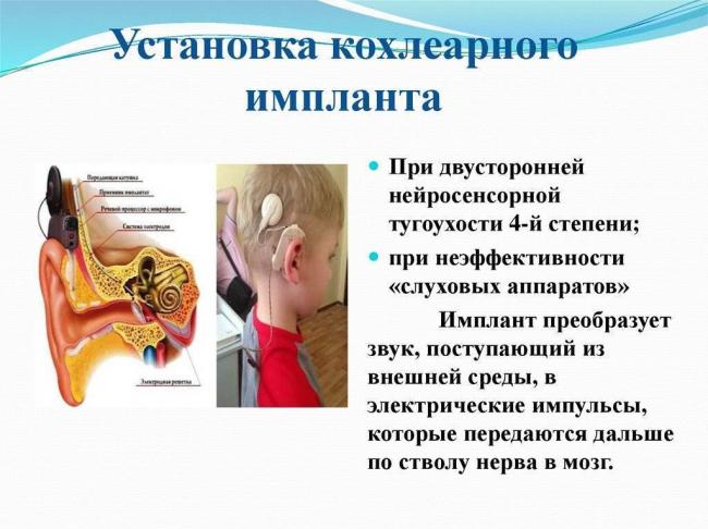 Особенности восстановления слуха при нейросенсорной тугоухости