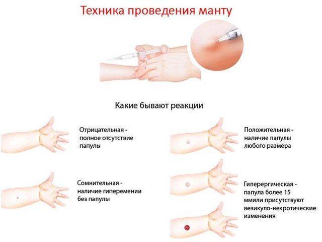 Долго не проходит след от манту — стоит ли паниковать?