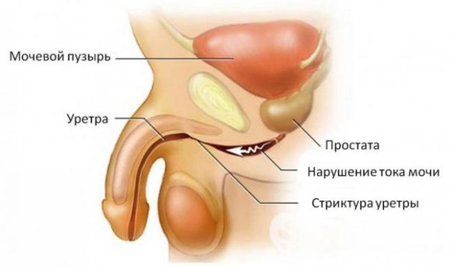 Уретрит у мужчин - симптомы, лечение, препараты, причины