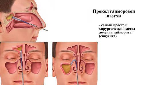 Гной после прокола гайморита