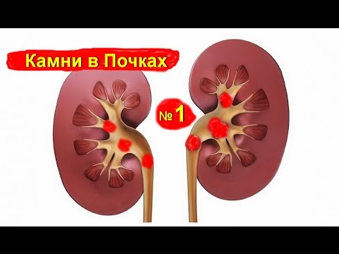 Камни в почках и мочевом пузыре: как избавиться от тяжкой ноши