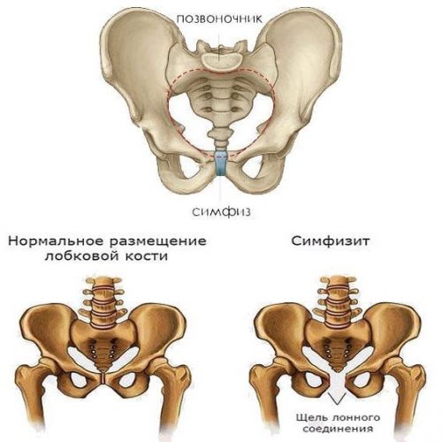 Беременность: трудно ходить и сидеть. что такое симфизит. медицинские аспекты беременности