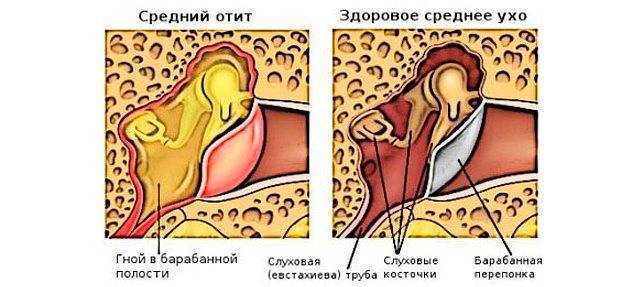 Антибиотики и ушные капли от отита у взрослых и детей