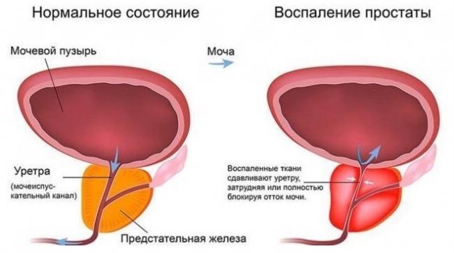 Лекарство афала от простатита, инструкция по применению, противопоказания, отзывы