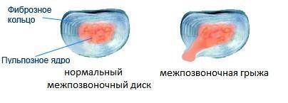 Как лечить грыжи и протрузии позвоночника?