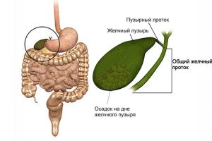 Сладж в желчном пузыре лечение