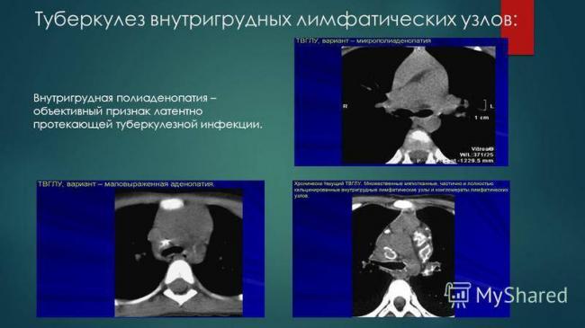 Туберкулёз лимфоузлов: симптомы, лечение, заразен или нет, диагностика