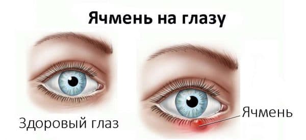 Что лучше при глазных инфекциях - тобрекс или альбуцид (сульфацил натрия)?