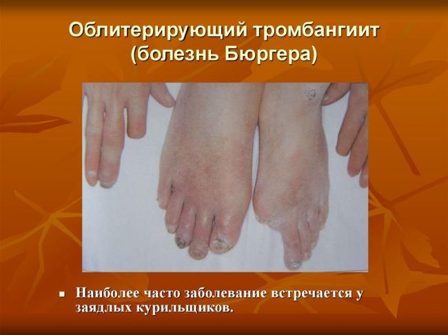 Болезнь бюргера — описание, диагностика, лечение