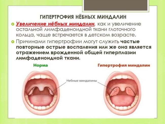 Лакунарная ангина у детей: лечение, фото горла, симптомы, код по мкб 10