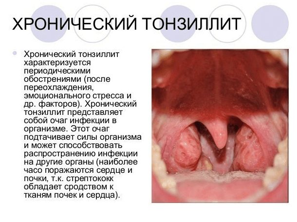 Симптомы и лечение хронического тонзиллита у взрослых