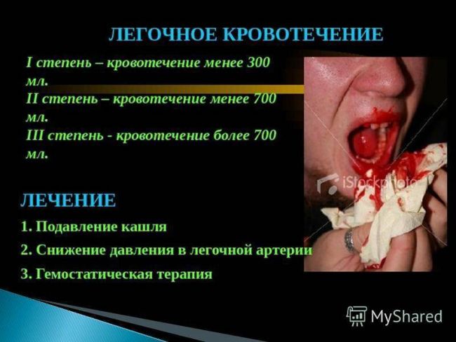 Кровохарканье при пневмонии: причины и даигностика